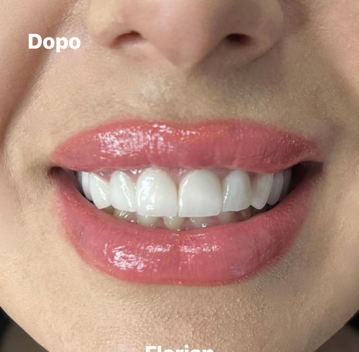 Dopo il trattamento dentale