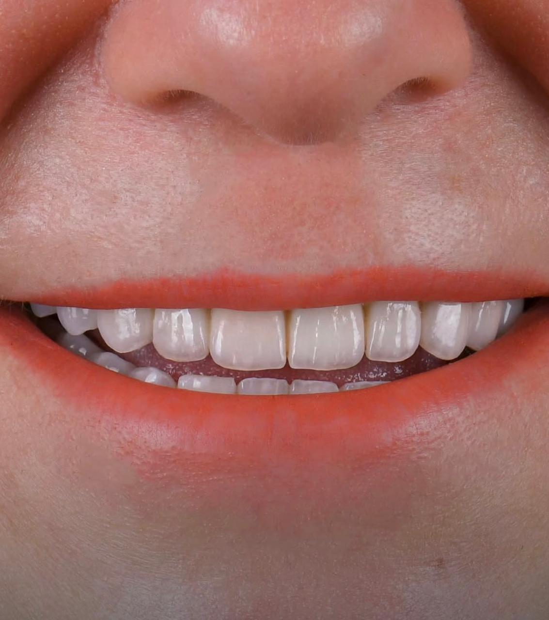 Dopo il trattamento dentale